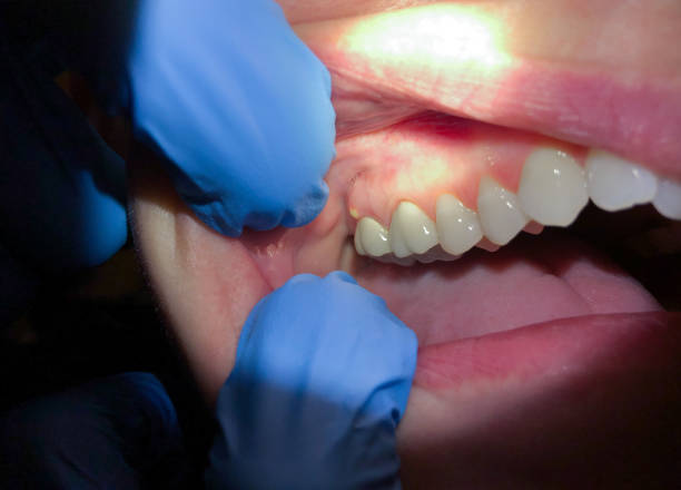 Best Emergency Wisdom Teeth Removal in Talluh, LA